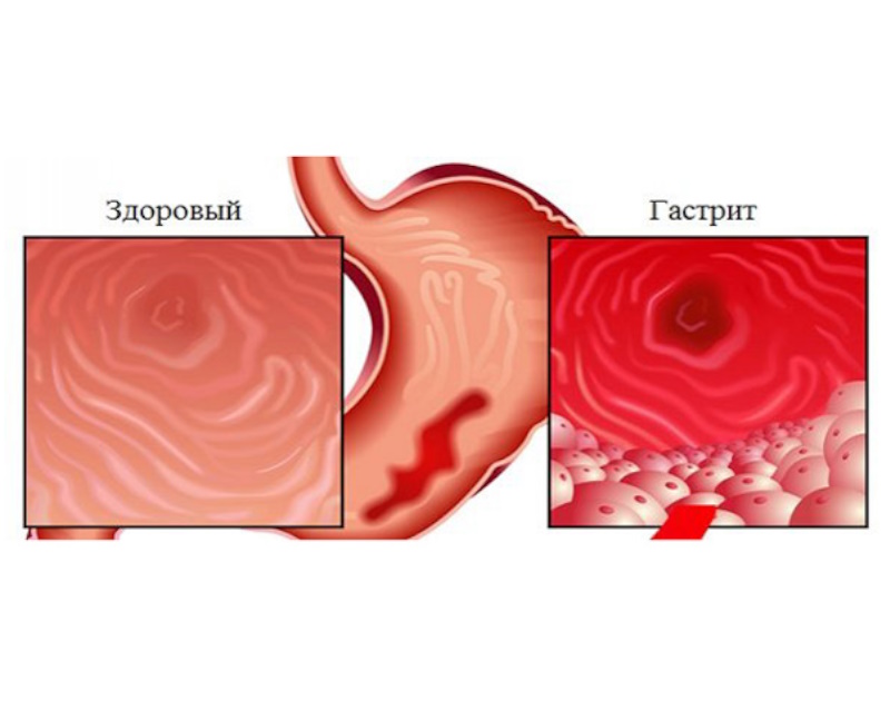Острый гастрит презентация