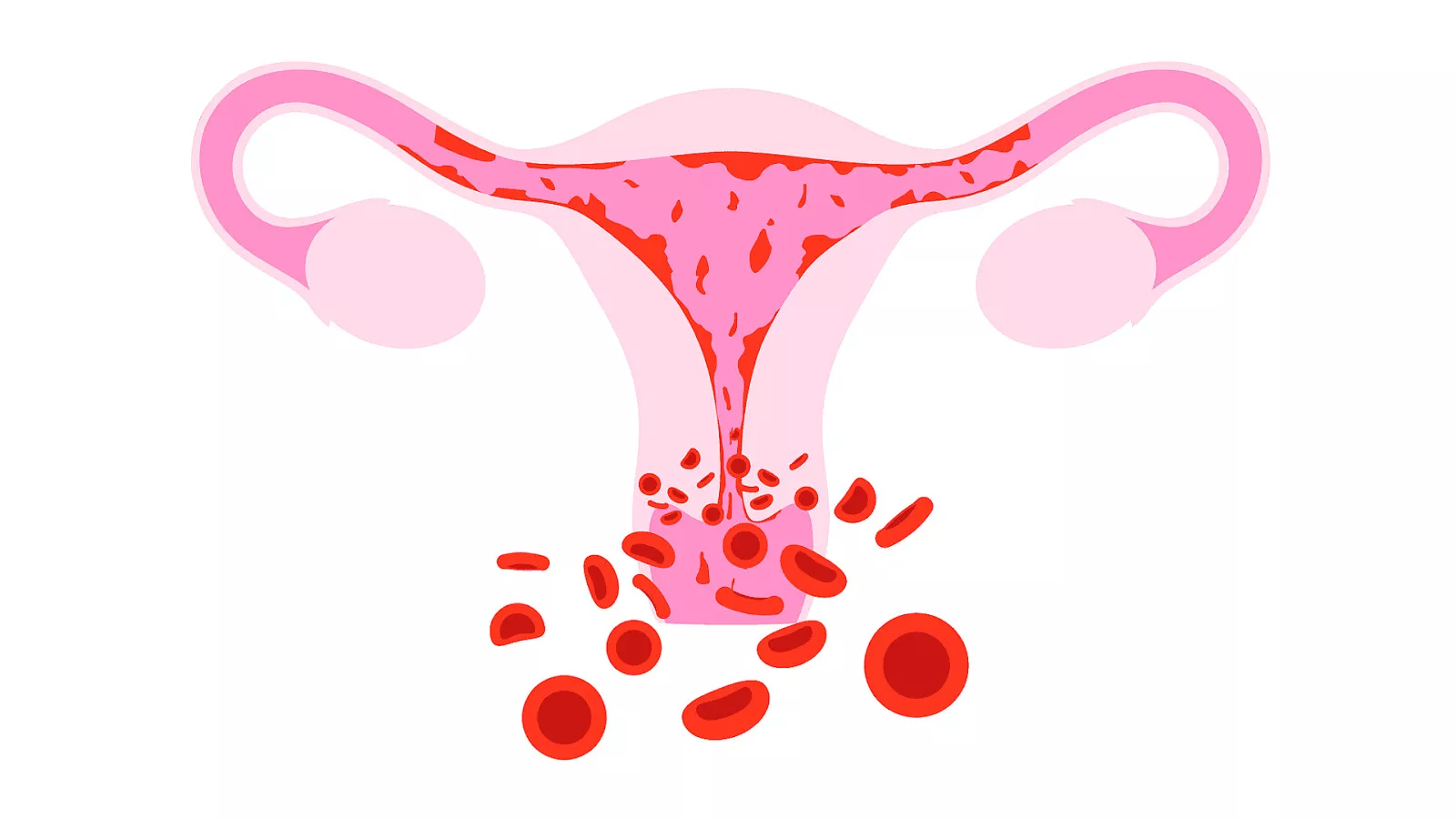Обильный менструационный цикл. Межменструальные маточные кровотечения. Обильное маточное кровотечение. Кровотечения в гинекологии.