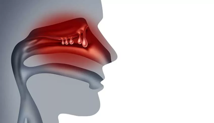 Полипы в носу – симптомы, причины, признаки и лечение у взрослых в «СМ-Клиника»