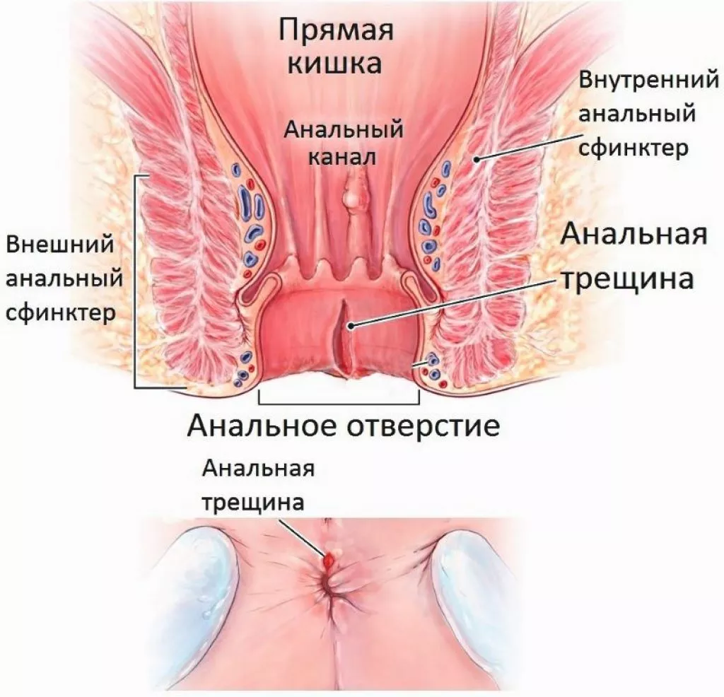 Анальные свищи - симптомы и диагностика, цены на лечение анальных свищей в Москве в клинике Хадасса
